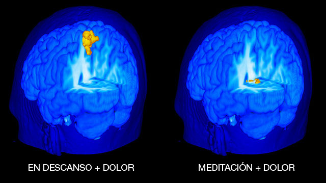 La imagen ilustra la actividad de la corteza somatosensorial primaria. Este área está muy actividad cuando hay dolor en periodo de descanso, pero está mucho menos activa cuando hay el dolor y se está meditando. Imágen: Fadel Zeidan